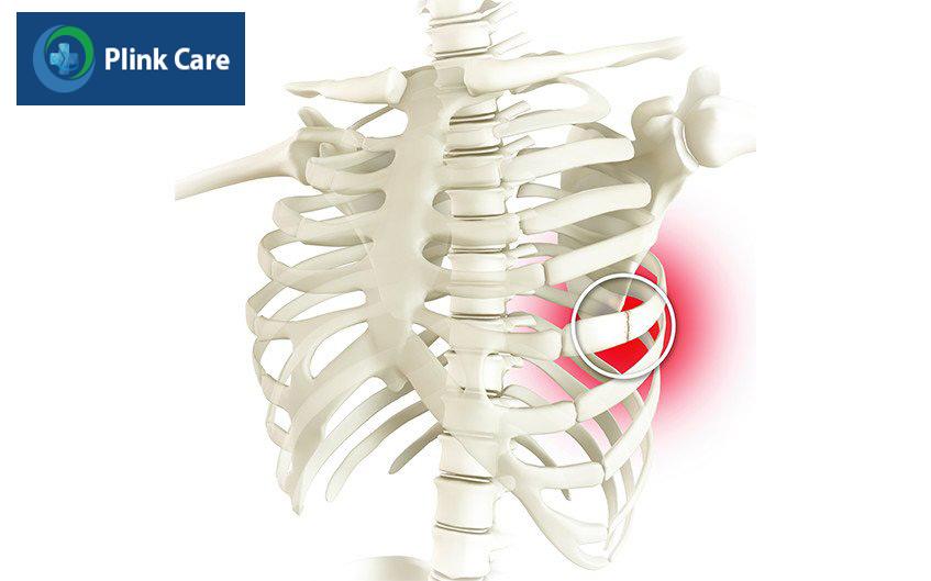các biến chứng khi bị gãy xương sườn