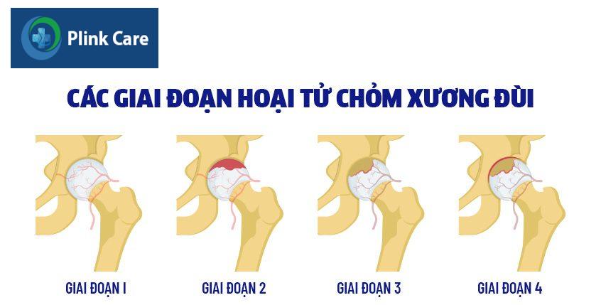 các giai đoạn chỏm xương đùi bị hoại tử