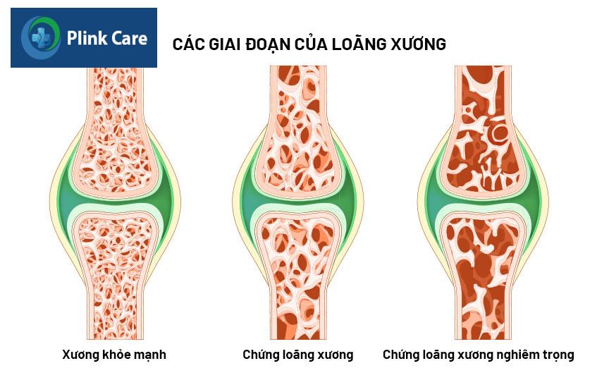 các giai đoạn xương bị loãng