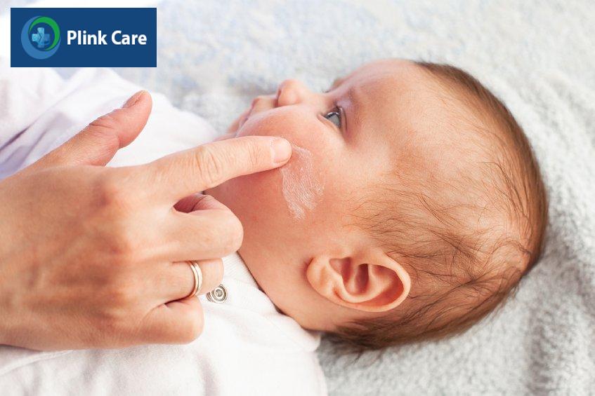 Cách điều trị bệnh viêm da cơ địa ở trẻ em