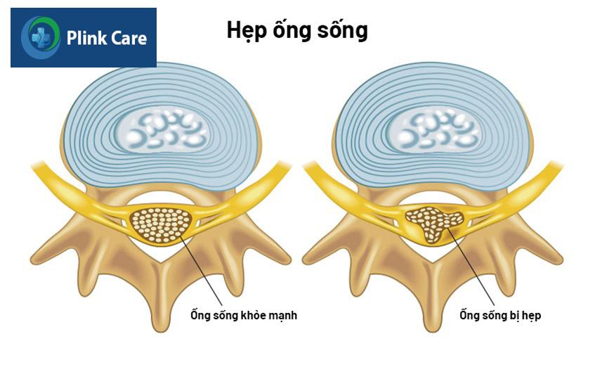 căn bệnh hẹp ống sống