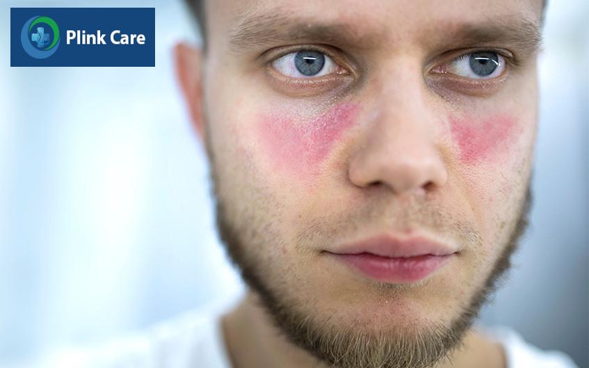 Cách chăm sóc người bệnh Lupus ban đỏ