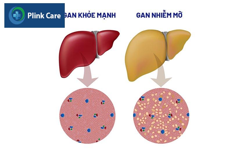 dấu hiệu gan nhiễm mỡ