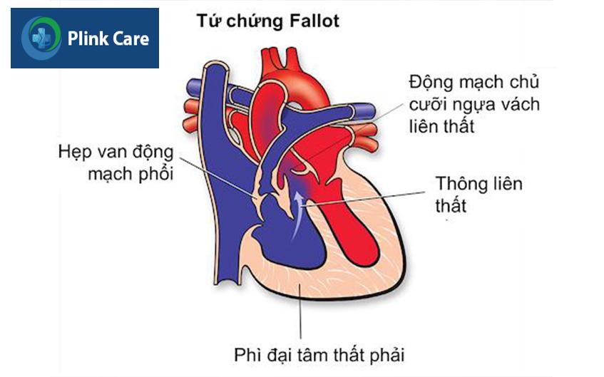 dị tật tứ chứng fallot 4 bẩm sinh