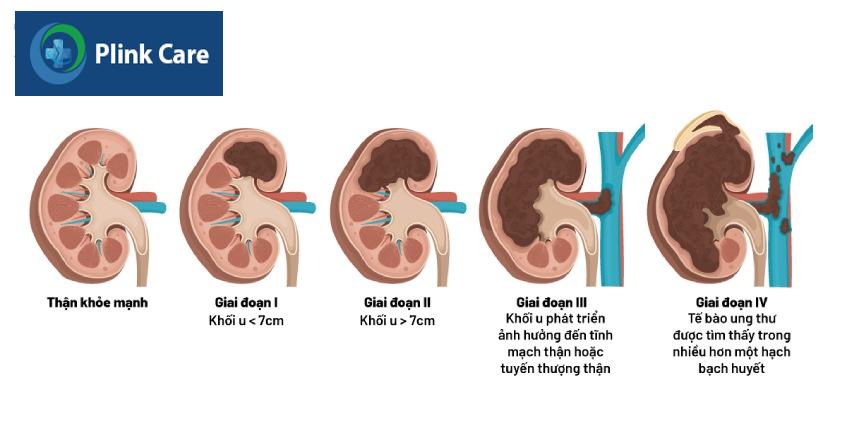 giai đoạn phát triển ung thư thận