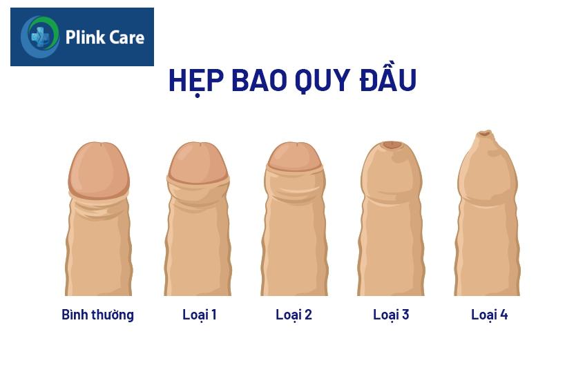 hẹp bao quy đầu