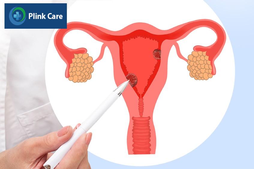 hình ảnh siêu âm buồng trứng bất thường