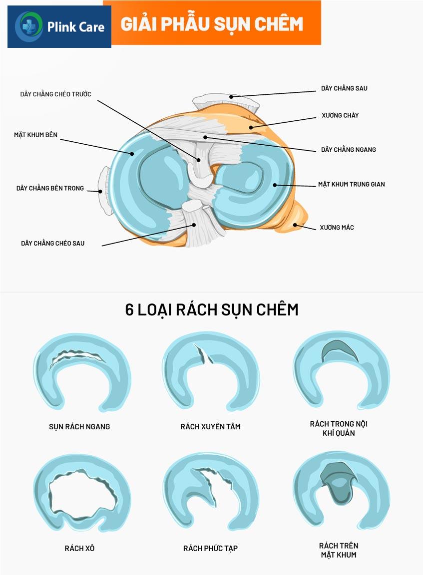 hình ảnh giải phẫu sụn chêm