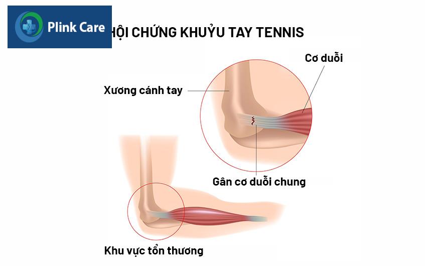 hội chứng khuỷu tay tennis