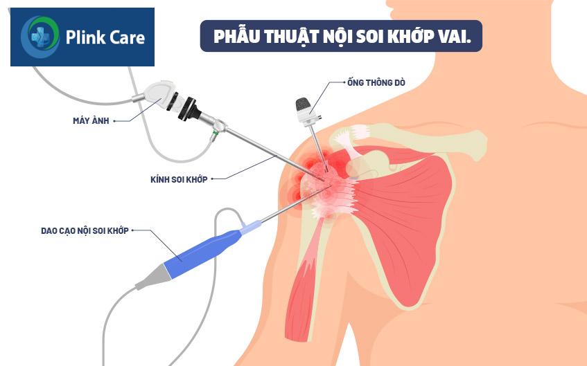 phẫu thuật khớp vai bằng nội soi