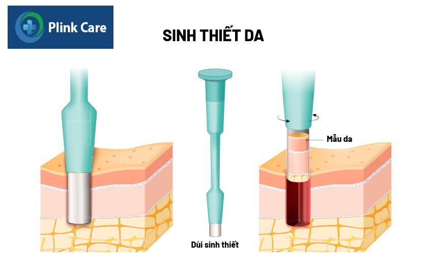 sinh thiết da