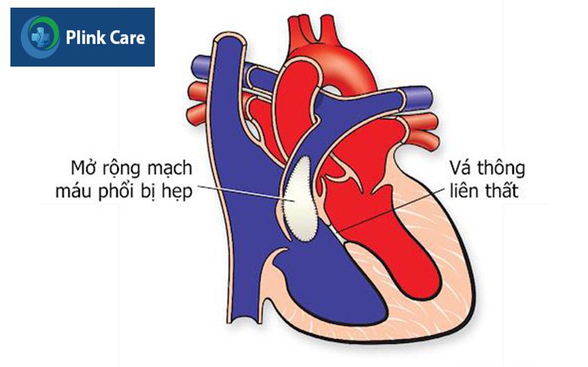 sữa chữa dị tật thông liên thất