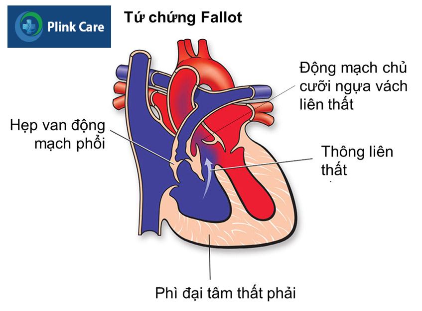 tổng quan về fallot 4