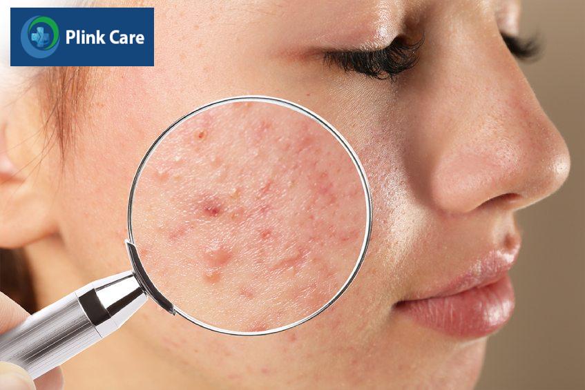 triệu chứng nhận biết mụn