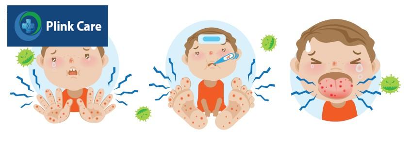 Triệu chứng và biến chứng bệnh tay chân miệng ở trẻ