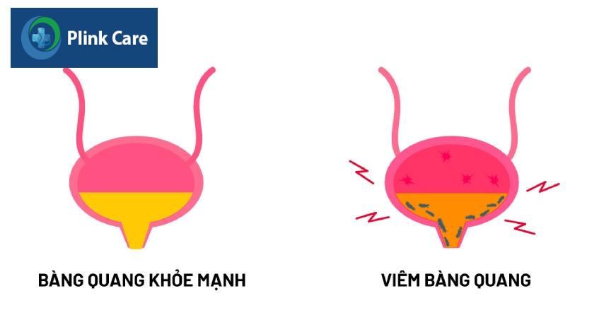 viêm bàng quang cấp