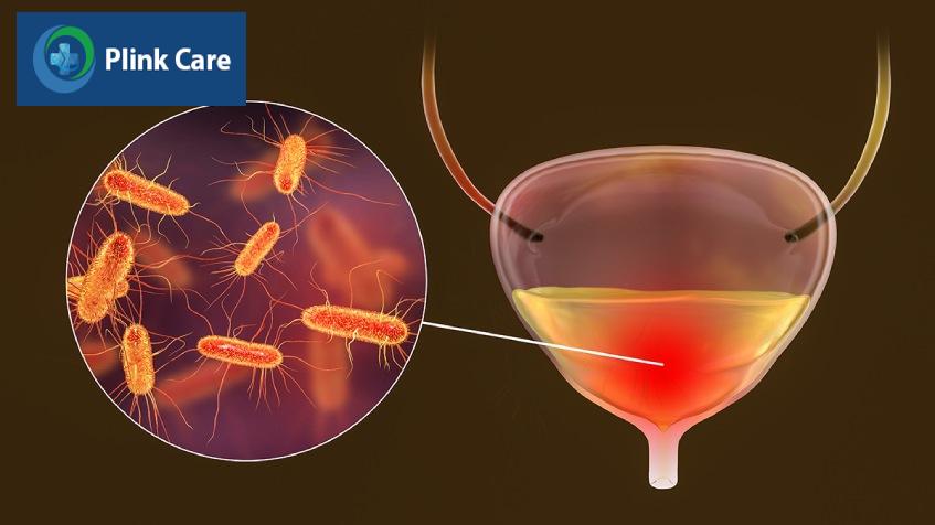 viêm bàng quang ở nữ giới là bệnh gì