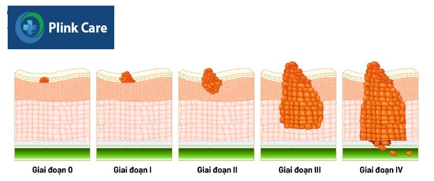 5 giai đoạn ung thư đại tràng