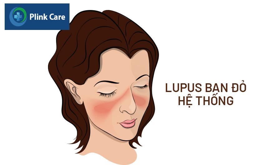 bệnh lupus hệ thống