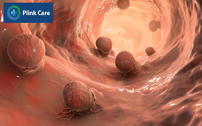 bệnh polyp đại tràng
