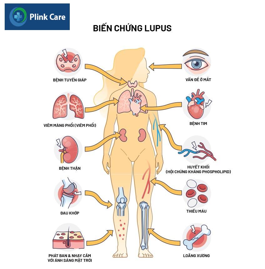 biến chứng lupus