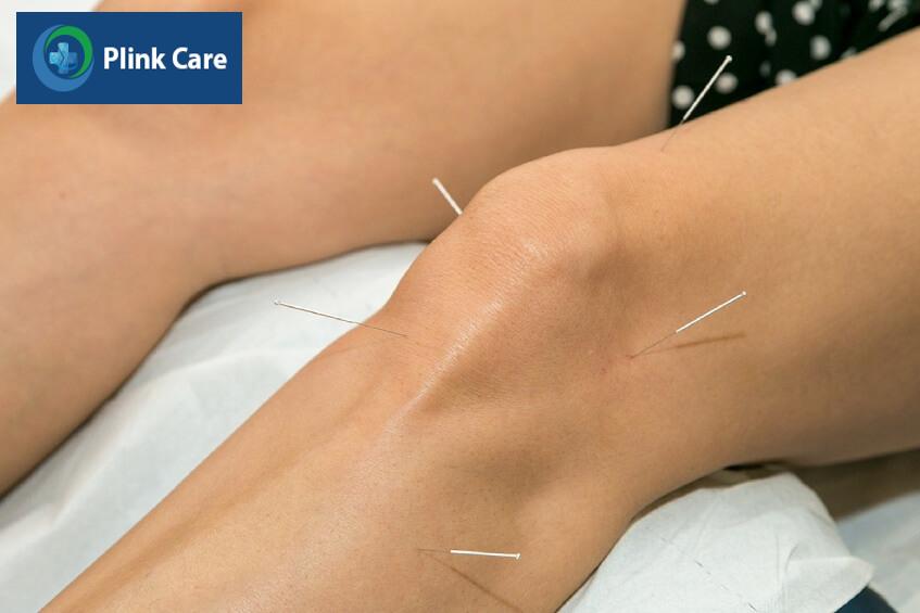 châm cứu sau điều trị tai biến