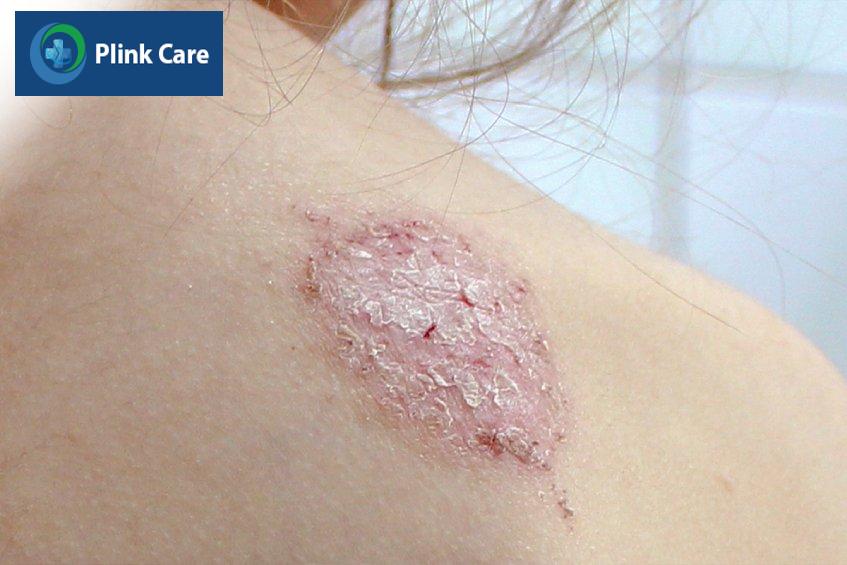chàm đồng tiền có nguy hiểm không