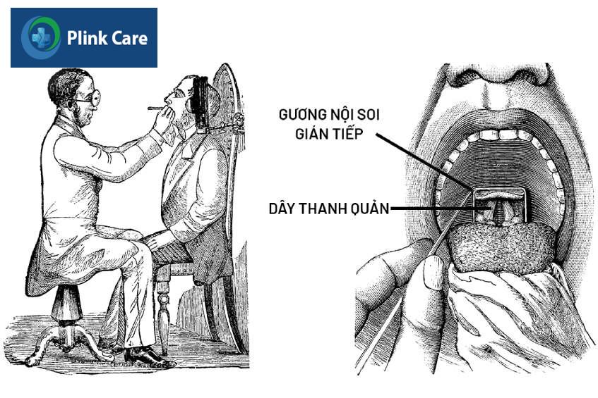 chỉ định nội soi thanh quản