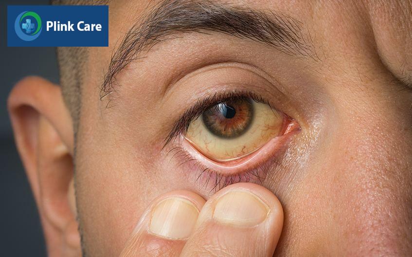 dấu hiệu viêm gan do rượu