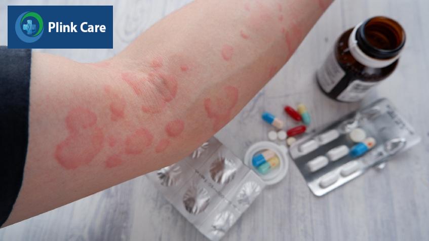 điều trị nổi mày đay