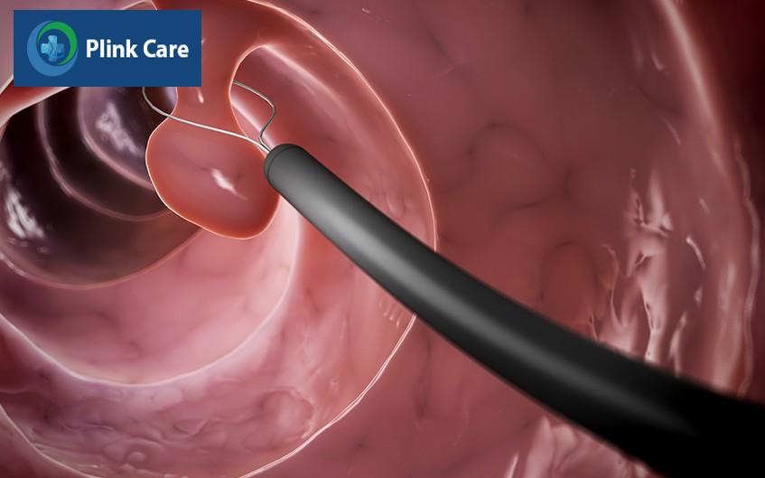 điều trị polyp đại tràng