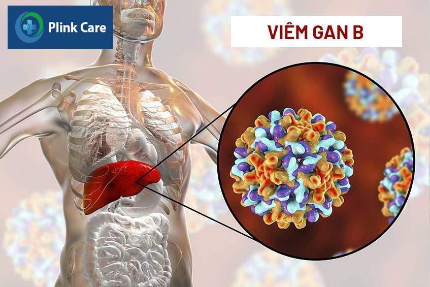 do viêm gan siêu vi b