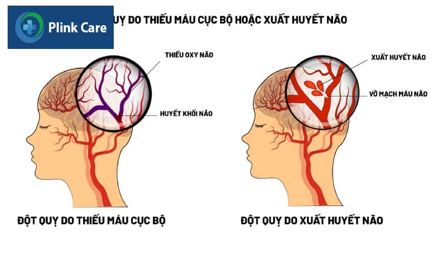 hai dạng tai biến mạch máu não