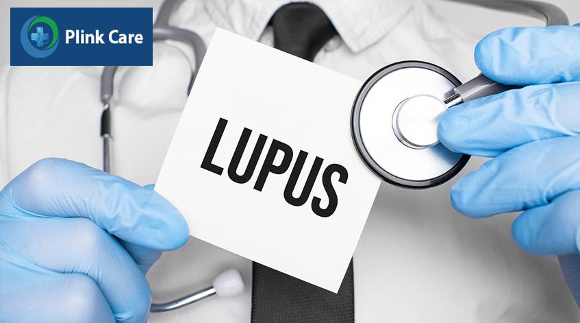 khám bệnh lupus