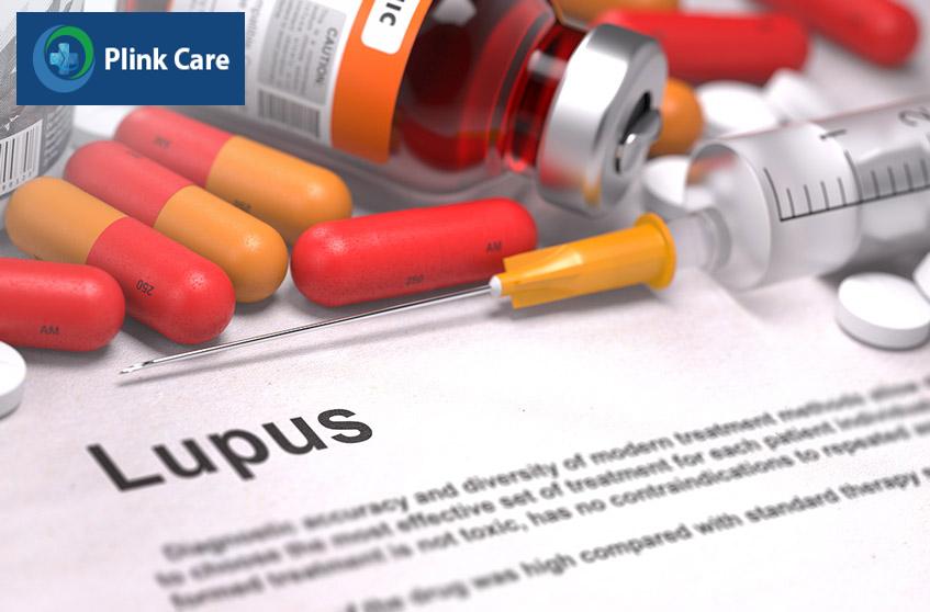 lupus ban đỏ có chữa dược không