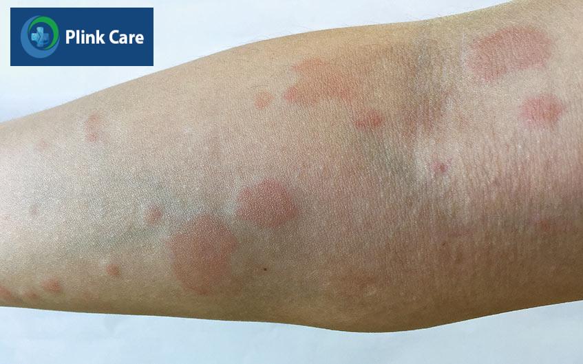 lupus dạng đĩa thời thơ ấu