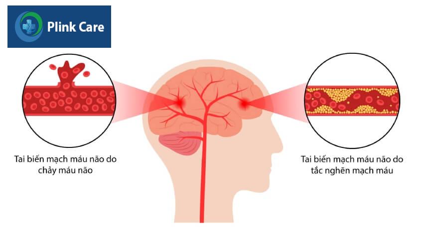 nguyên nhân tai biến mạch máu não