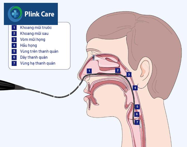 nội soi thanh quản trực tiếp bằng ống mềm