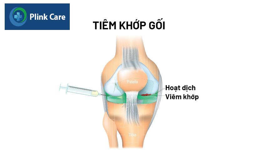 phương pháp tiêm thuốc vào khớp gối