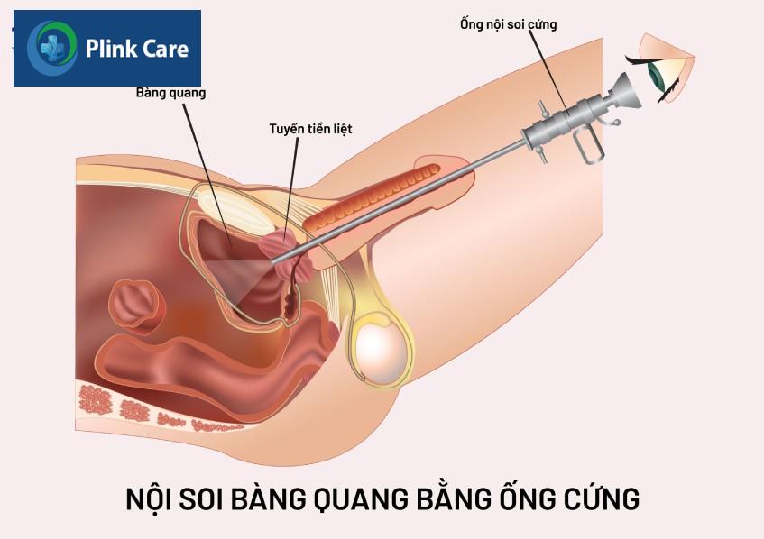 quy trình nội soi bàng quang bằng ống cứng