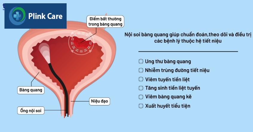 soi bàng quang