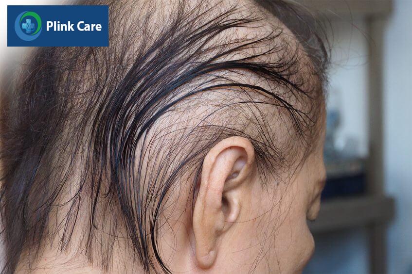tác dụng phụ của điều trị u não