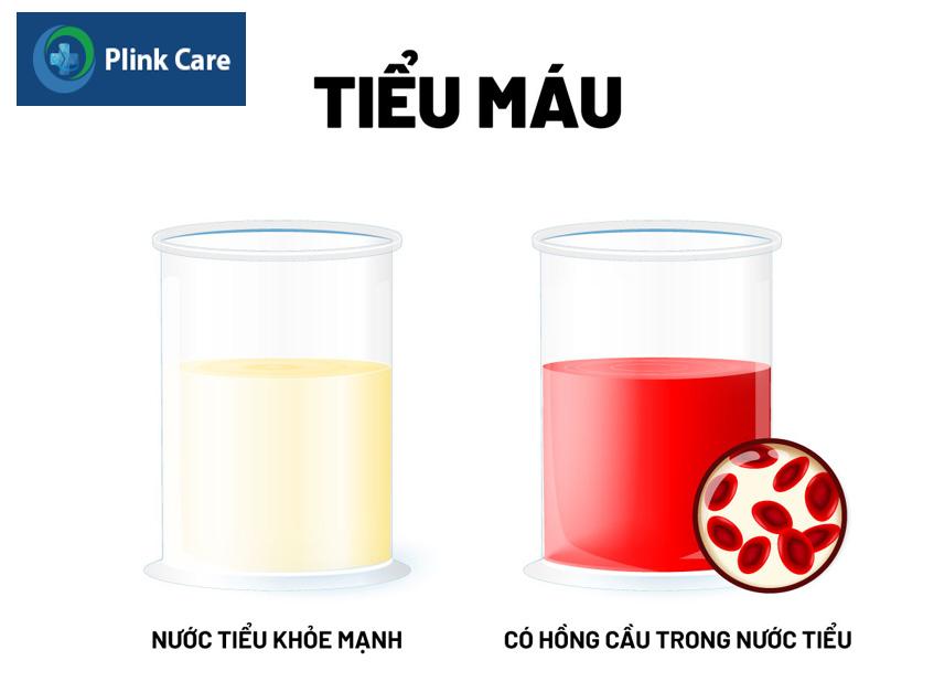 thương tổn ở thận