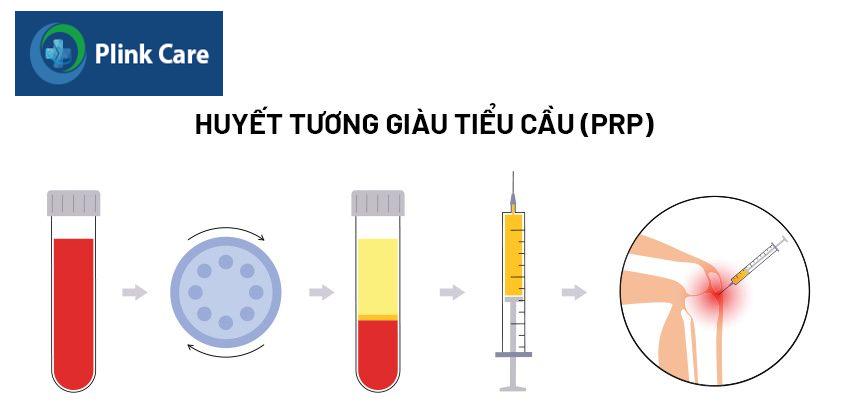 tiêm prp vào khớp gối