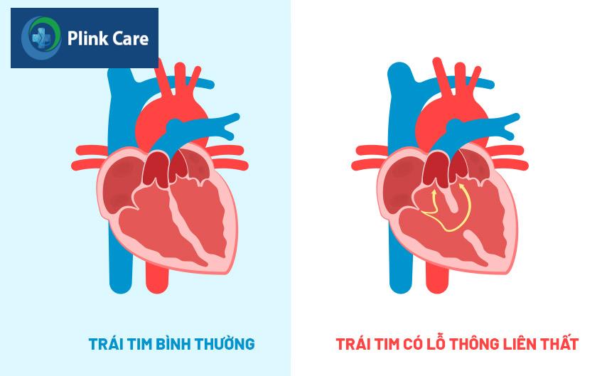 tim mạch có lỗ thông liên thất
