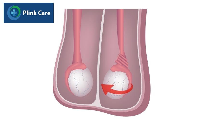 Tinh hoàn lạc chỗ có thể gây xoắn tinh hoàn