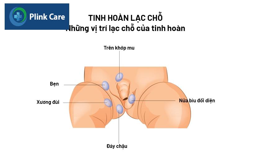 tinh hoàn lạc chỗ là gì