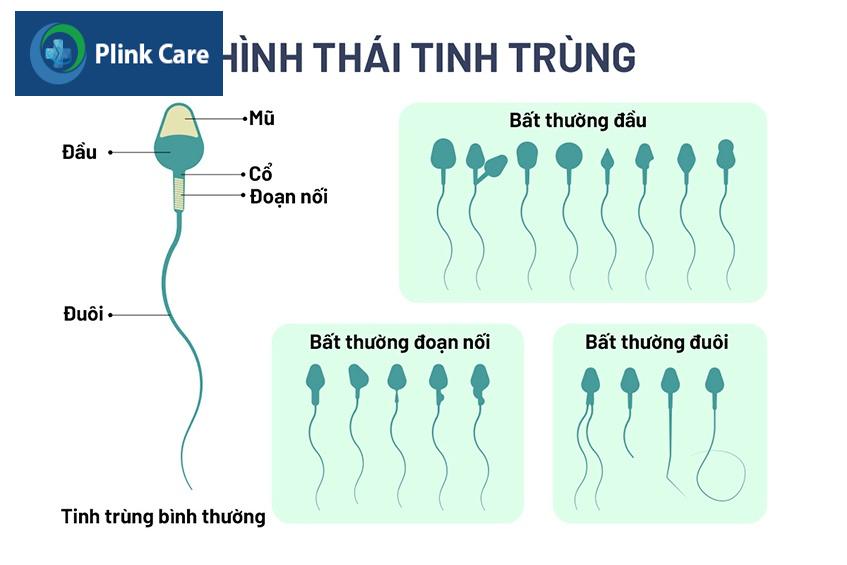 Tinh trùng dị dạng có thể gây vô sinh nam