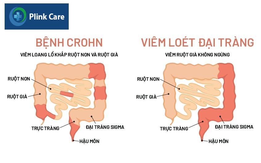 triệu chứng viêm ruột mạn tính