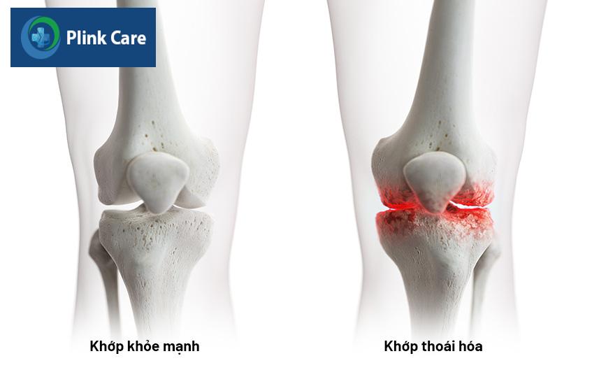 trường hợp khớp gối bị thoái hóa